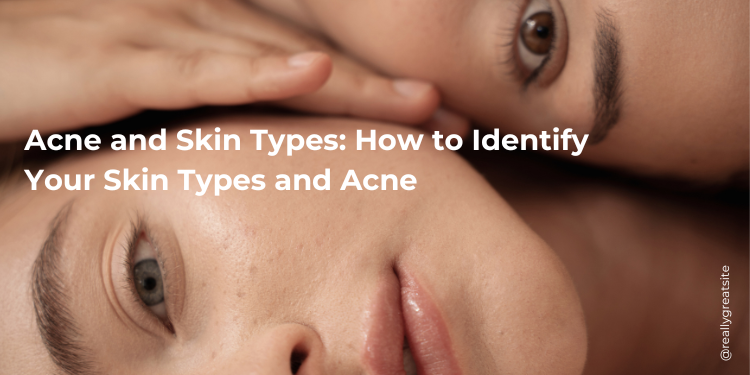 acne skin types and recommended treatment